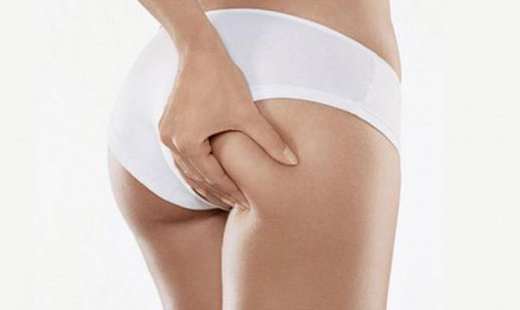 Zlikvidujte nepríjemnú pomarančovú pokožku na vašo