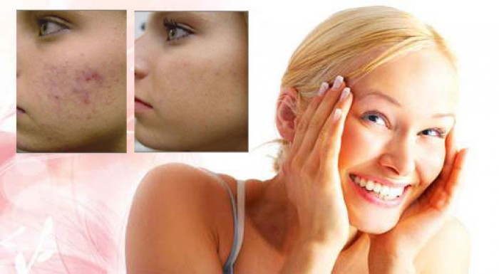 Zbavte sa pigmentových škvŕn a rozšírených pórov