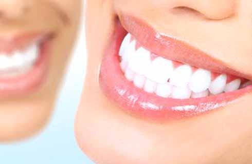 Profesionálne bielenie zubov špičkovou americkou t