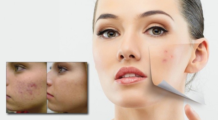 Rozžiarte svoju pleť pomocou hĺbkového čistenia pl