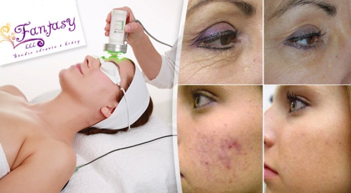 Mezoterapia proti vráskam, jazvám po akné alebo dvojitej brade v salóne Fantasy LLL.