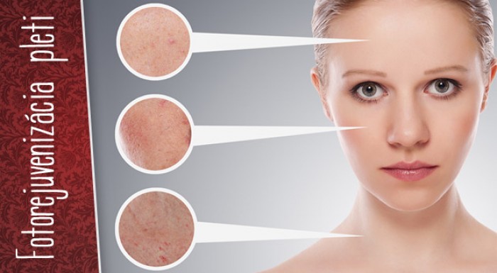 Fotorejuvenizácia pleti - IPL ošetrenie