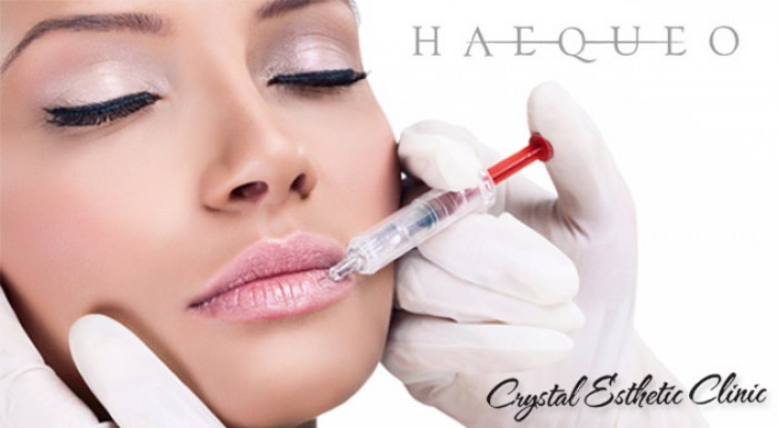 Výplň časti tváre kyselinou hyalurónovou