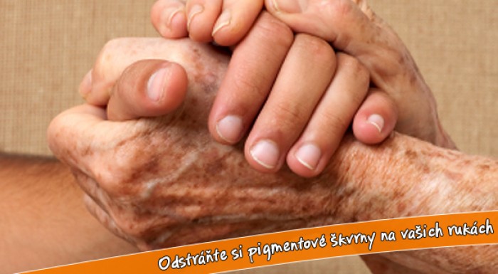Odstránenia pigmentových škvŕn na rukách.