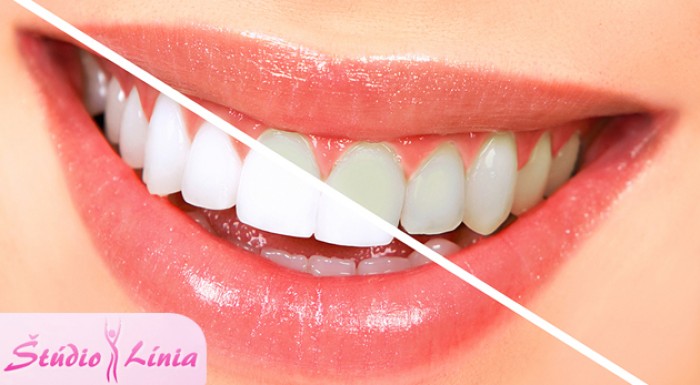 Bielenie zubov bez peroxidu