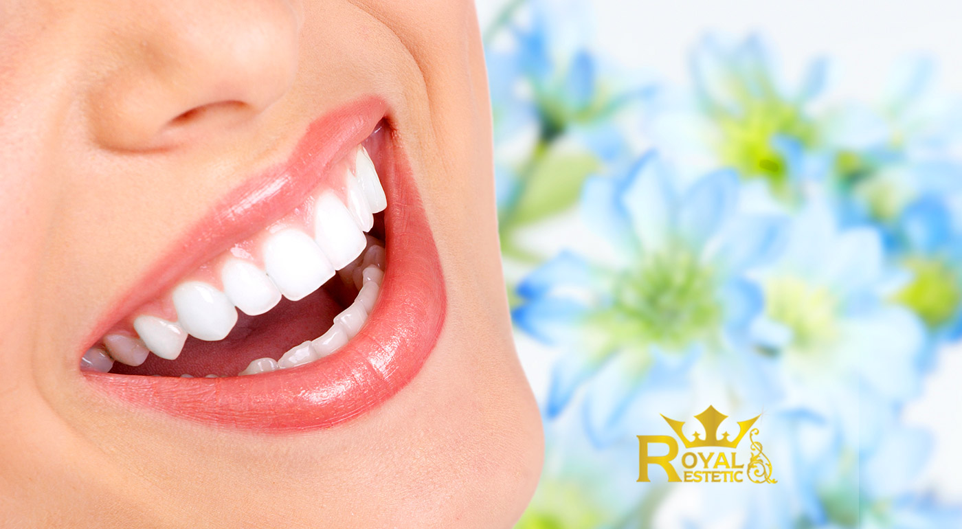 Profesionálne bielenie zubov