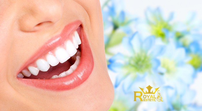 Profesionálne bielenie zubov