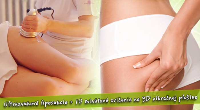 Centrum Ultrazvukovej Liposukcie - ultrazvuková liposukcia + 10 min. cvičenie na vibračnej plošine.
